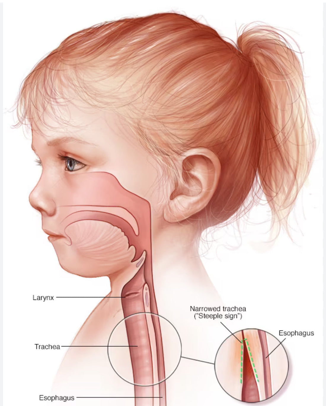 Croup