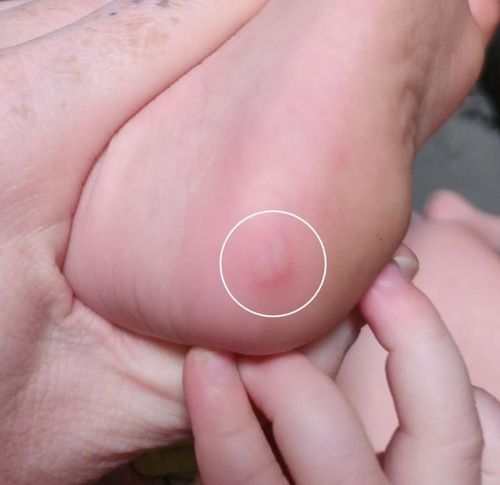 Hand foot and mouth disease