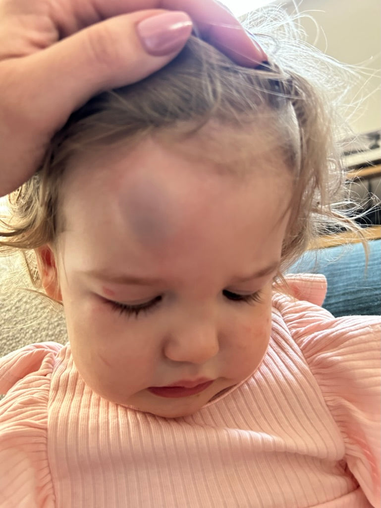 Head injuries
