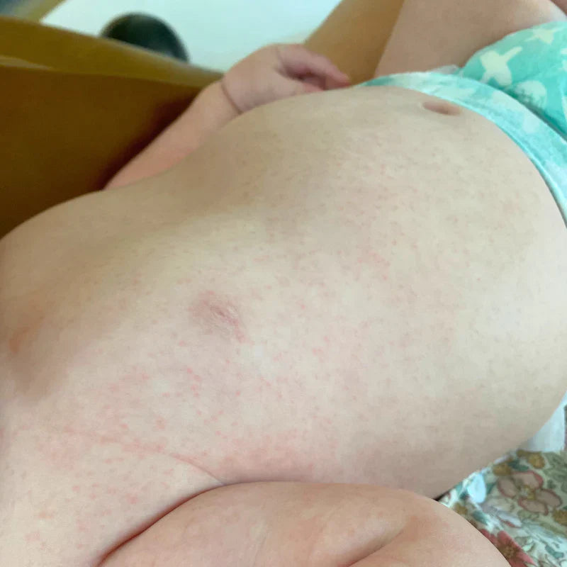 Not another rash!